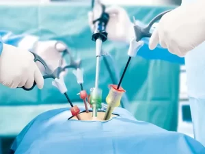 لاپاراسکوپی