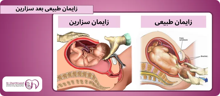 زایمان واژینال بعد سزارین