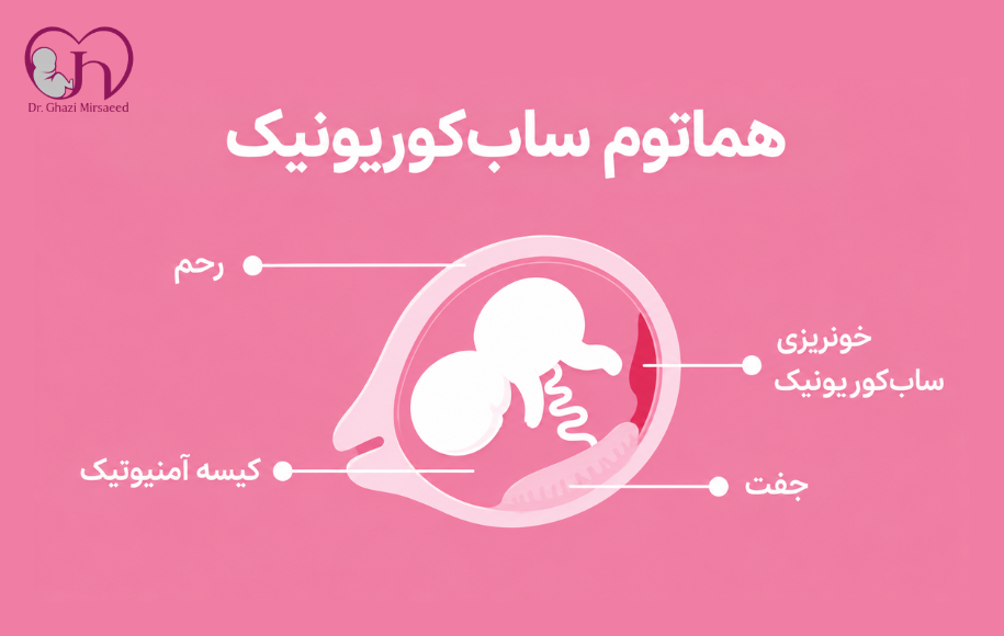 هماتوم در بارداری چیست؟