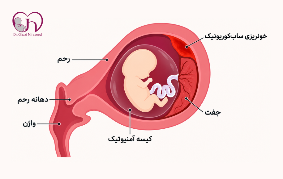 خطرهای هماتوم بارداری
